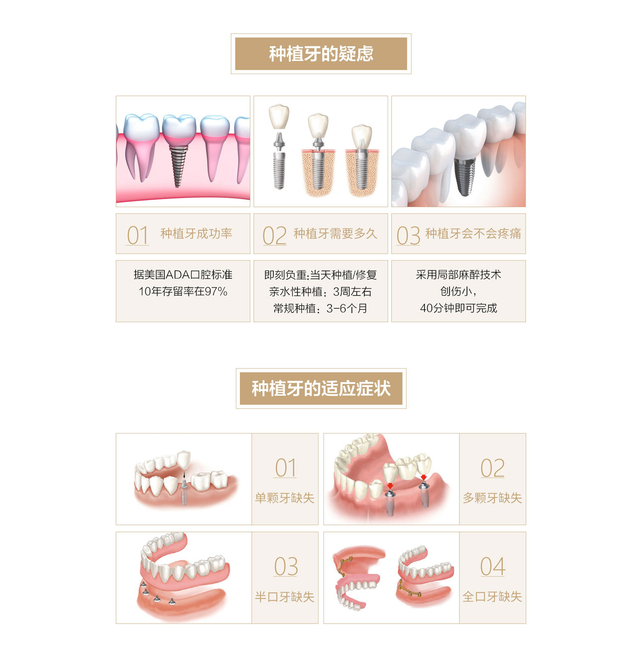 最新种植牙技术，时代进步为口腔健康带来希望之光